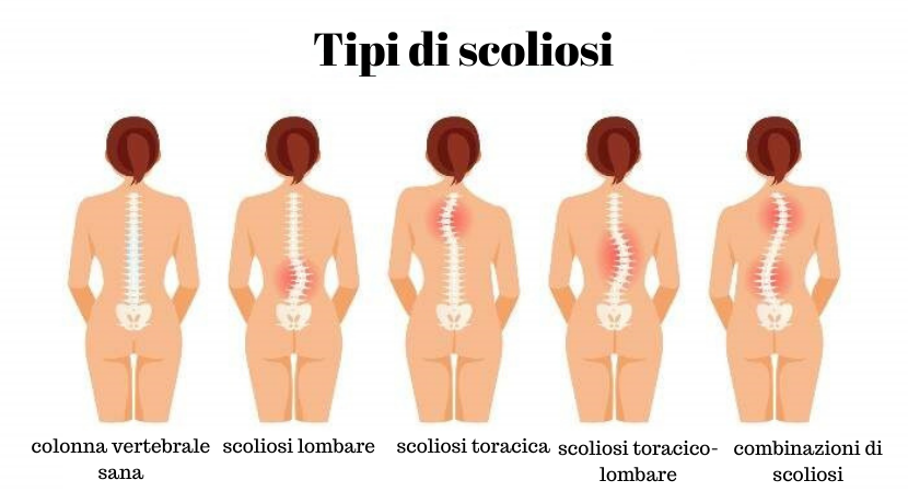 Quanti tipi di scoliosi esistono