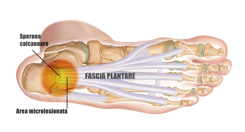 cosa è la fascite plantare